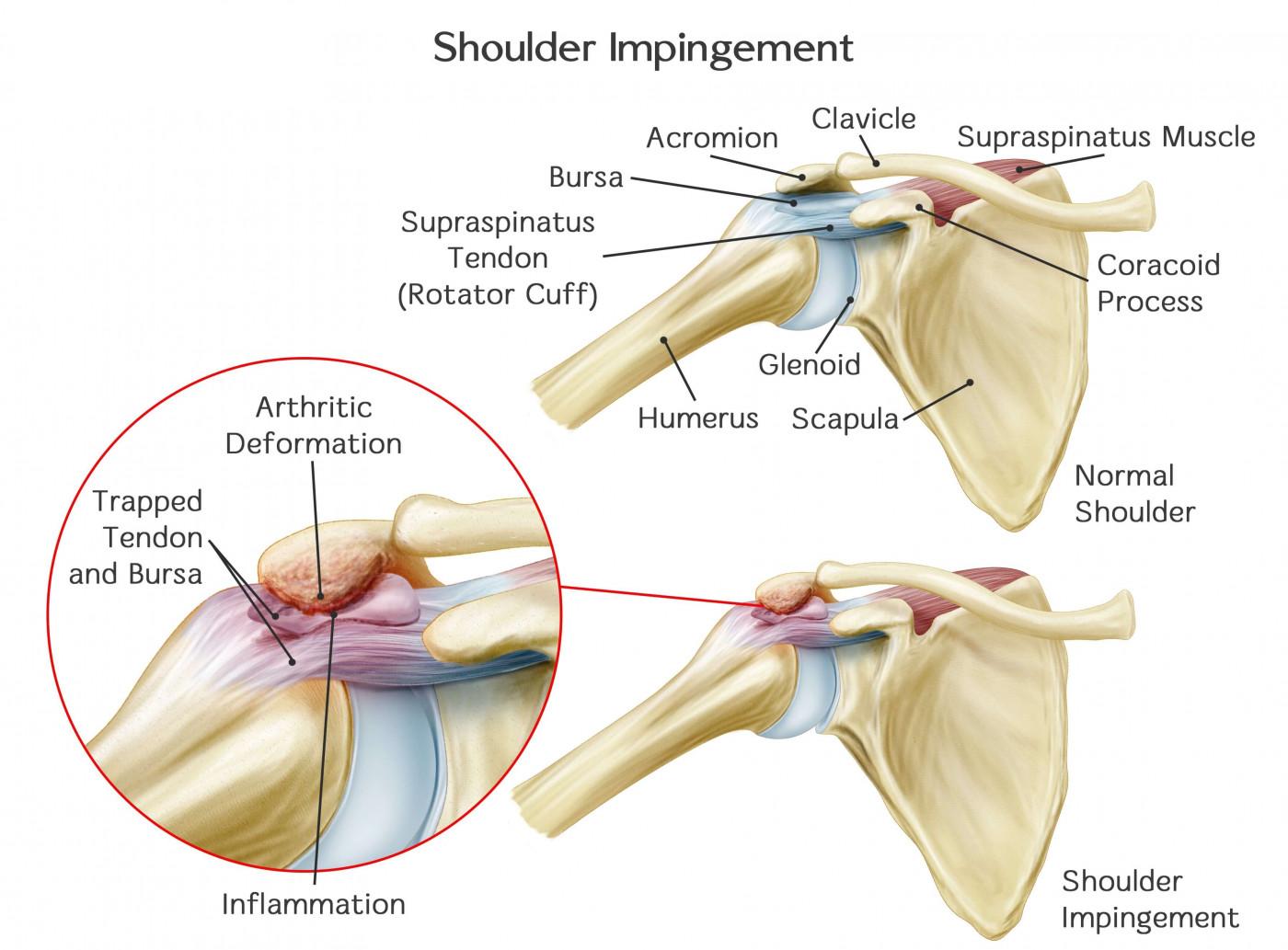 shoulder_impingement_syndrome